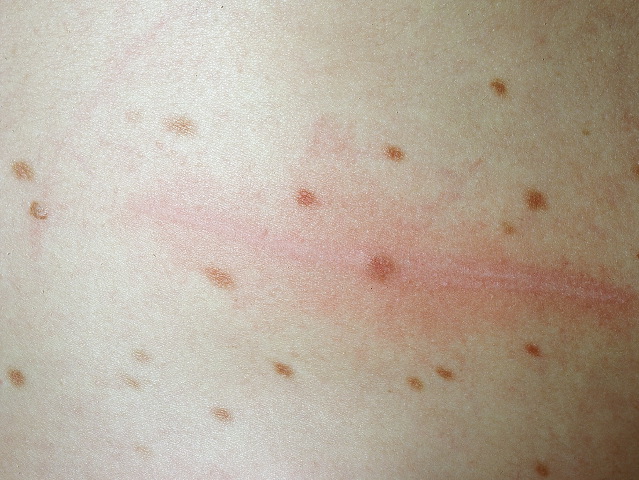 mastocytosis